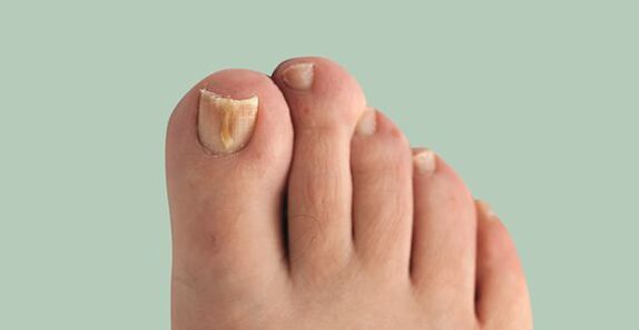 tratamentul pantofilor cu ciuperci ale unghiilor și picioarelor